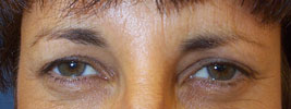 BOTOX� injections