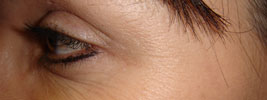 BOTOX� injections