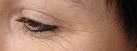 BOTOX� injections