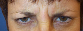 BOTOX� injections