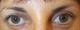 BOTOX� injections
