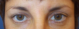 BOTOX� injections